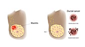 Mastitis and ductal cancer comparison, illustration