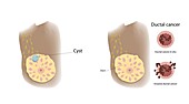 Cyst and ductal cancer comparison, illustration