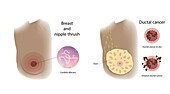 Thrush and ductal cancer comparison, illustration