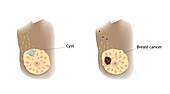 Cyst and breast cancer comparison, illustration