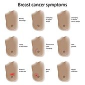 Breast cancer symptoms, illustration