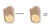 Healthy breast and fibroadenoma, illustration
