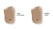 Healthy breast and lump, illustration