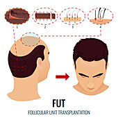 FUT hair transplantation stages, illustration