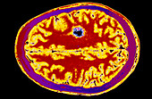 Coloured MRI scan of brain cancer (glioma)