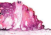 Seborrheic keratosis, light micrograph