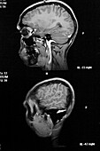 Myeloma, MRI scan