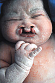Baby with a complete bilateral cleft lip