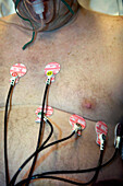 Electrodes attached to a patient's chest