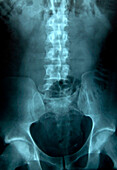 Lumbar vertebrae, X-ray