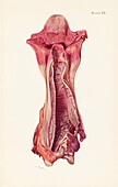 Ulceration of a trachea after mustard gas poisoning