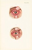 Eye severely burned by exposure to mustard gas, illustration