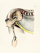 Forceps delivery, 19th century illustration