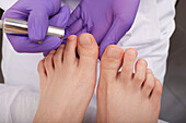Laser treatment for fungal toenail infection