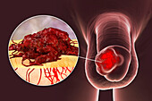 Penile cancer, illustration