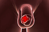 Penile cancer, illustration