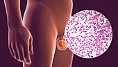 Testicular cancer, illustration and light micrograph