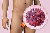 Testicular cancer, illustration