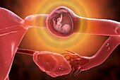 Ectopic pregnancy, illustration