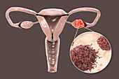 Ovarian cancer, illustration