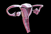 Polycystic ovary syndrome, illustration