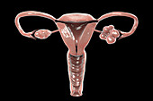 Polycystic ovary syndrome, illustration