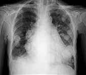 Cannonball pulmonary metastases, X-ray