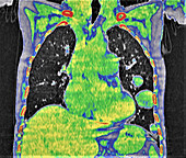 Cannonball pulmonary metastases, CT scan