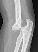 Dislocated elbow, X-ray