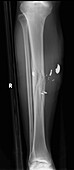 Gun shot in leg, X-ray