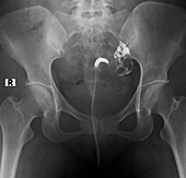Malformed uterus, X-ray