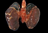 Adrenal glands in Waterhouse-Friderichsen syndrome