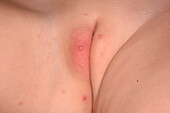 Molluscum contagiosum