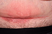 Rash on skin flap of LSCS scar
