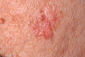 Basal cell skin cancer on the chest