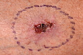 Squamous cell carcinoma marked before skin excision surgery