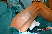 Skin graft donor site