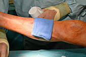 Dressing being applied on top of a skin graft