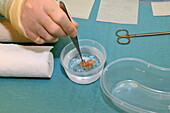Skin graft being placed in a sterile saline solution