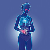 Organs affected by lupus autoimmune disease, illustration