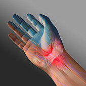 Carpal tunnel syndrome, illustration