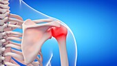 Painful shoulder, illustration