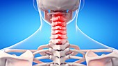 Painful cervical spine, illustration