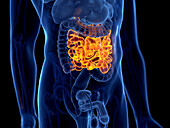 Cancer of the small intestine, illustration