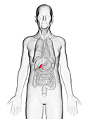 Elderly man's gallbladder, illustration