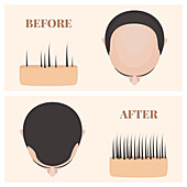 Alopecia treatment, illustration