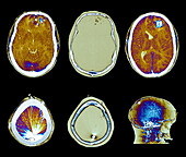 Firearm injury, CT scan