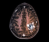 Arteriovenous malformation, MRI scan