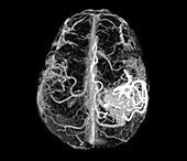 Arteriovenous malformation, MRI scan