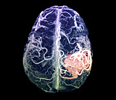 Arteriovenous malformation, MRI scan